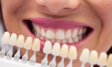 Faceta de porcelana comparada a guia de cor